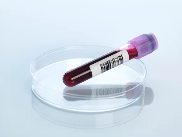 Detecting Alzheimer’s Gets Easier with a Simple Blood Test